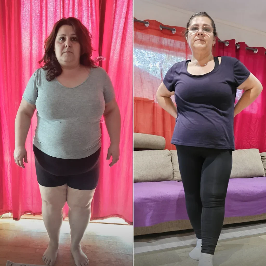 Botox gastrico prima e dopo, risultato 23