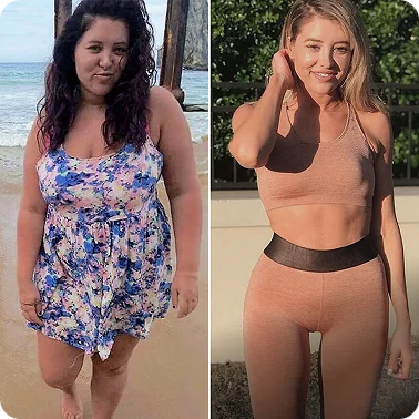 Bypass gastrico prima e dopo, risultato 1