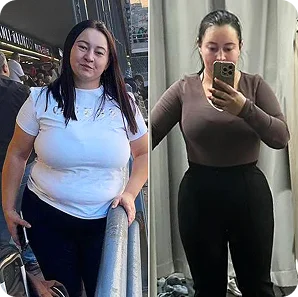 Bypass gastrico prima e dopo, risultato 2