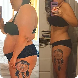 Bypass gastrico prima e dopo, risultato 3