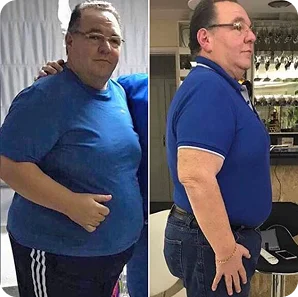 Bypass gastrico prima e dopo, risultato 5
