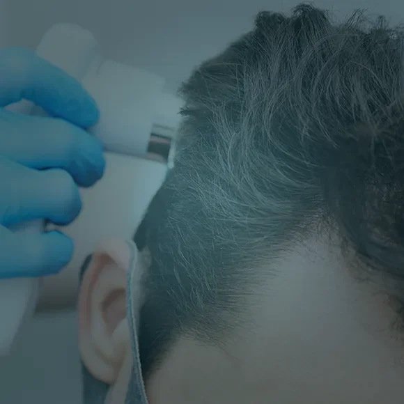 Trapianto di capelli DHI