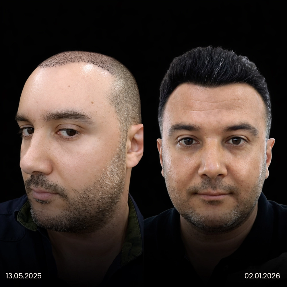 Trapianto di capelli in Turchia prima e dopo, risultato 12
