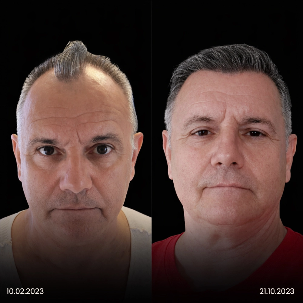 Trapianto di capelli in Turchia prima e dopo, risultato 3
