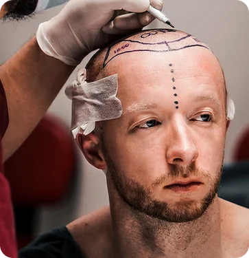Tecniche di trapianto di capelli