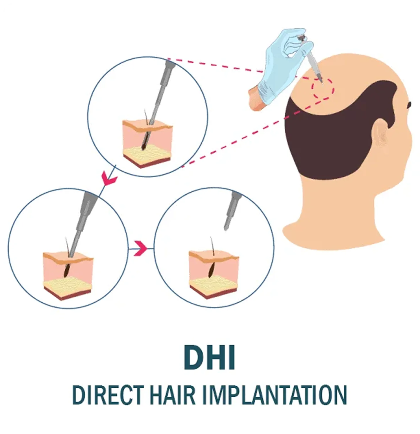 Trapianto di capelli DHI