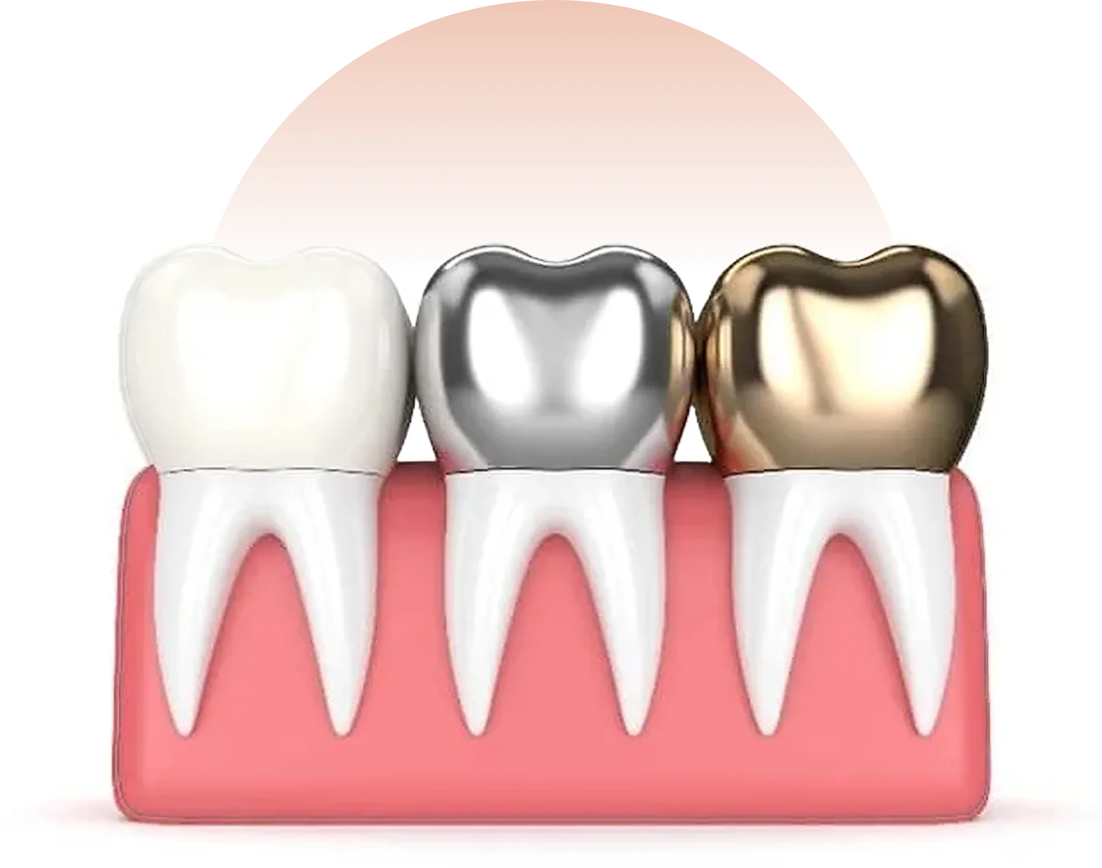 Smile makeover con corone dentali