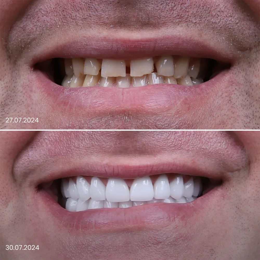 costo degli impianti dentali a bocca intera