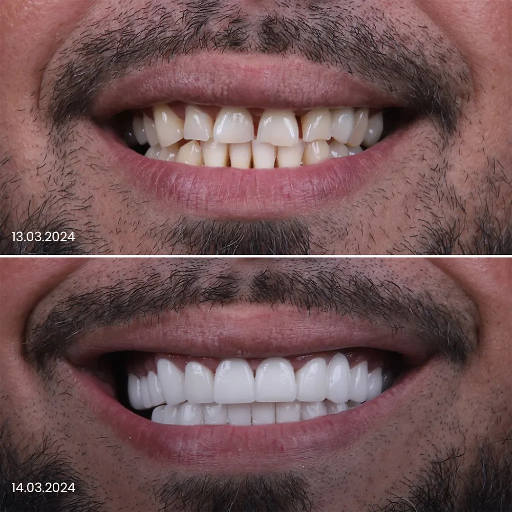 impianto dentale arcata completa