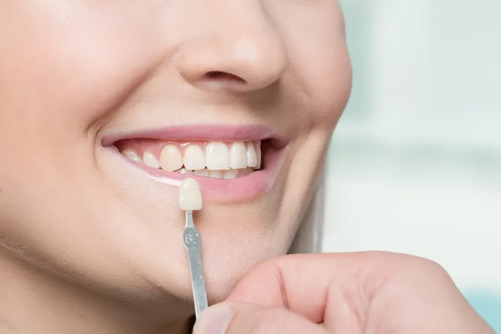 Hollywood Smile in Turchia con faccette