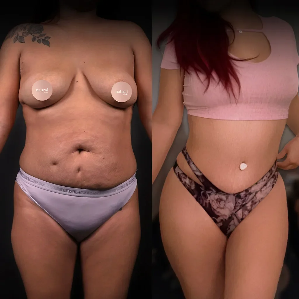 Risultato prima e dopo della liposuzione 2