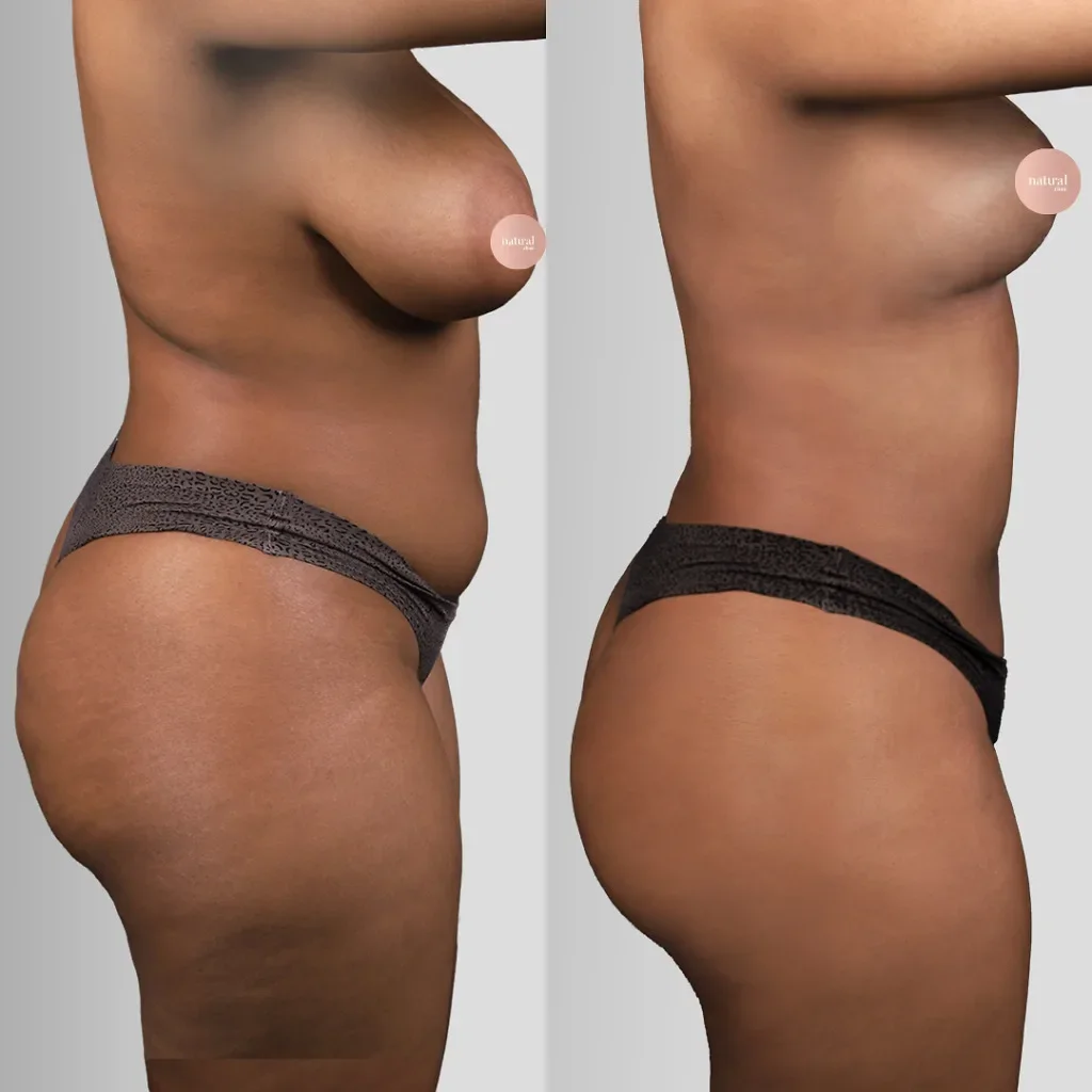 Risultato prima e dopo della liposuzione 4
