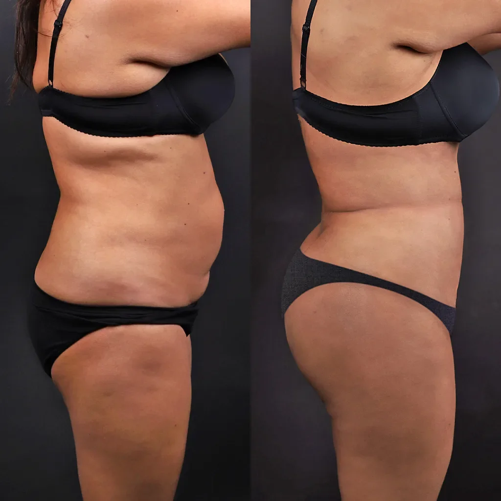 Risultato prima e dopo della liposuzione 6