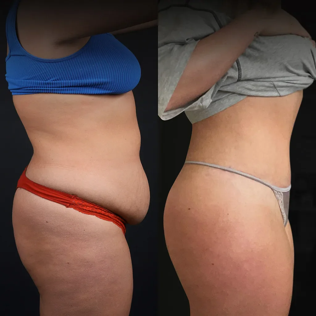 Risultato prima e dopo della liposuzione 8