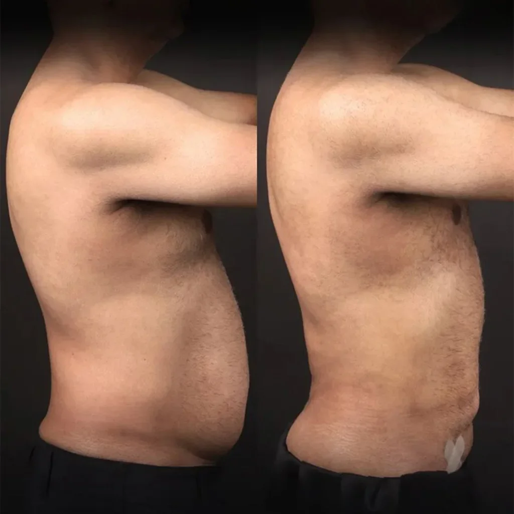 Risultato prima e dopo della liposuzione 9