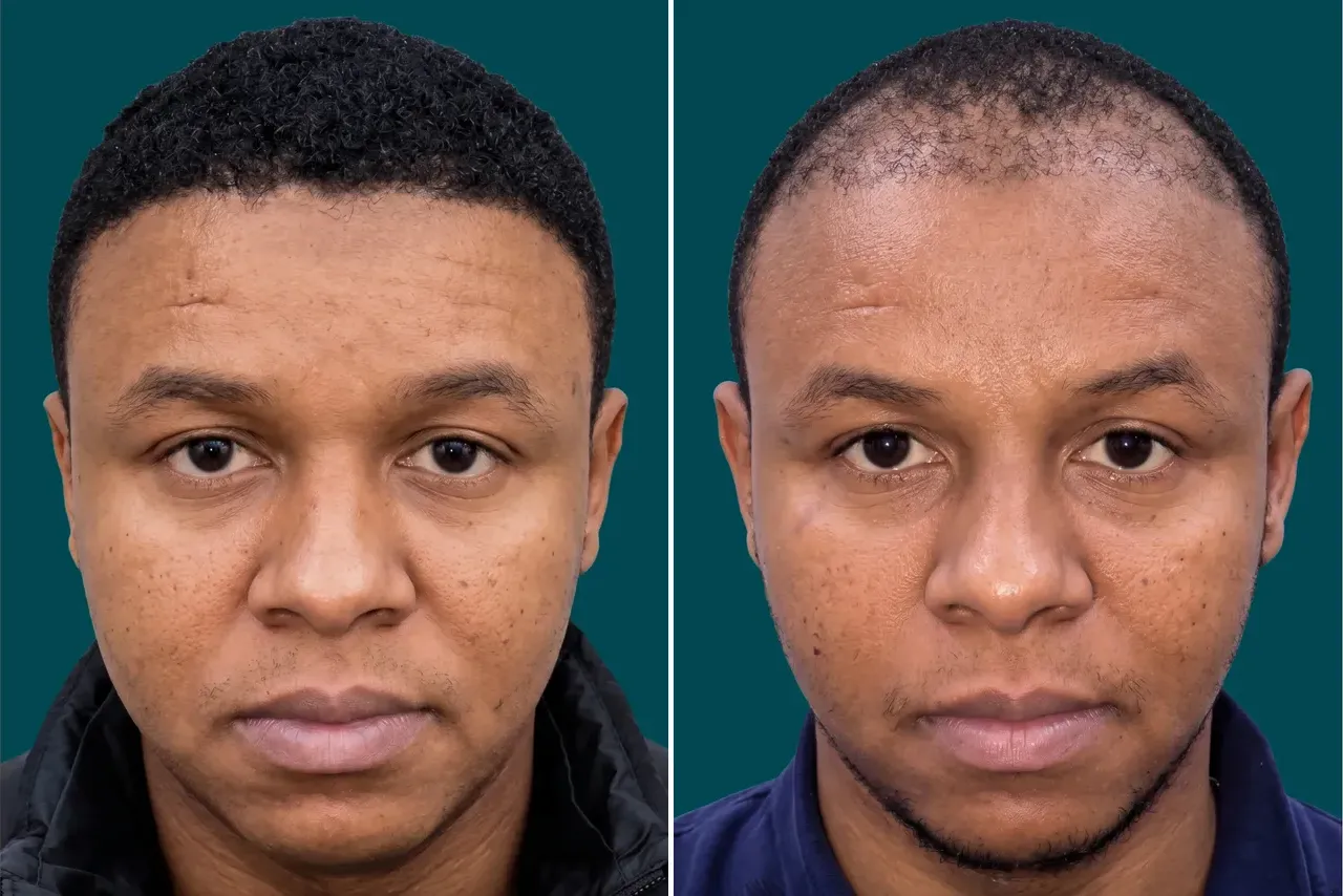 Afro Hair Transplant