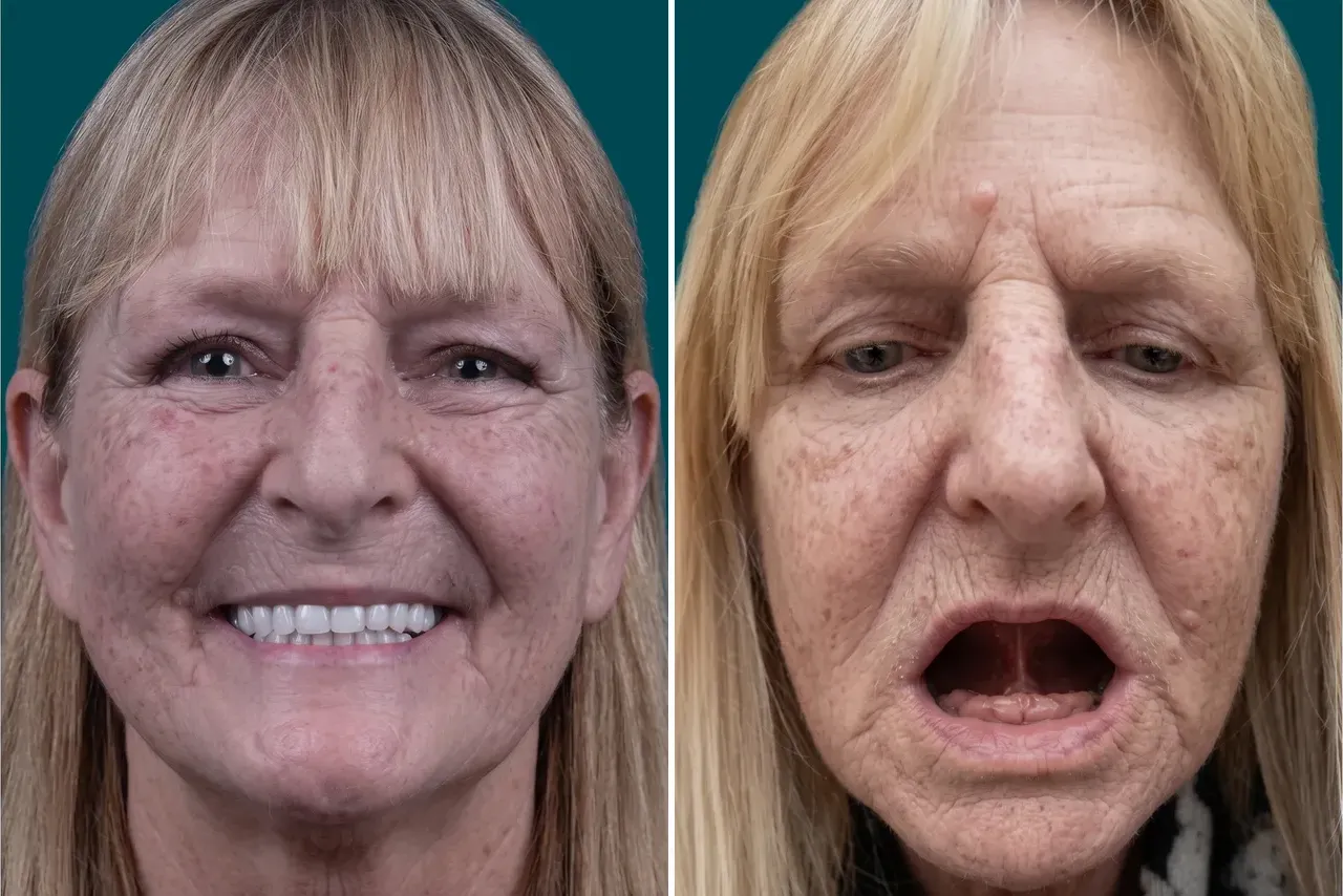 Dental Implants-All on 4 2