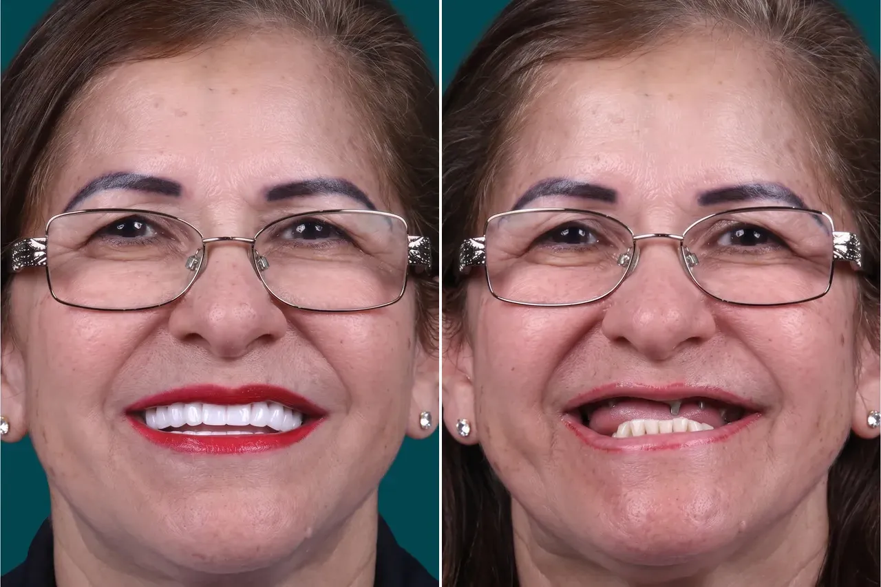 Dental Implants-All on 4 3