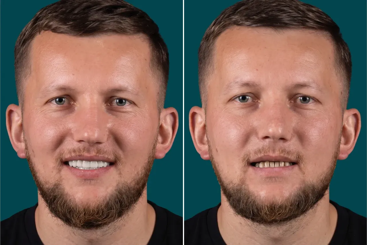 Dental Implants-All on 4 4