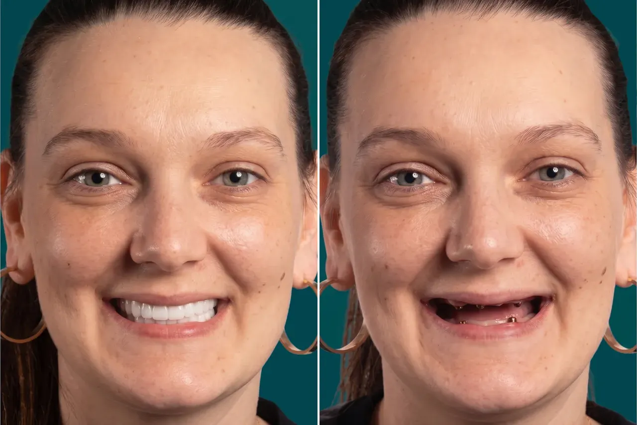Dental Implants-All on 4 5