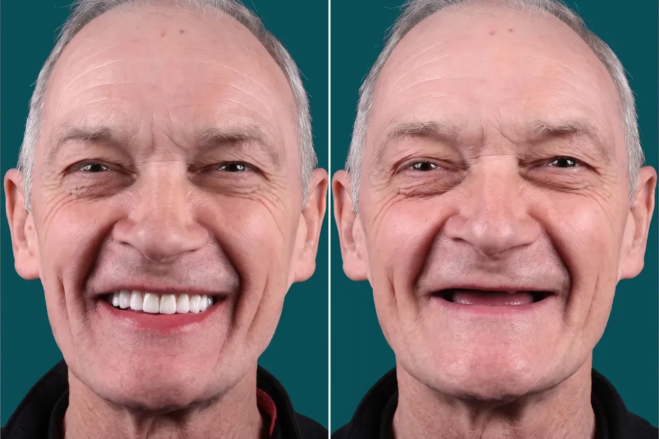 Dental Implants-All On 6 1