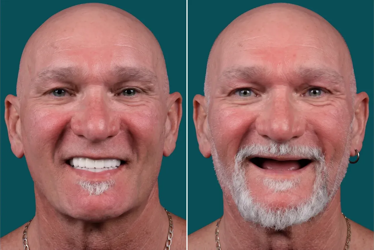 Dental Implants- All On 6 2
