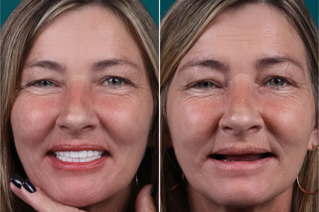Dental Implants-All On 6