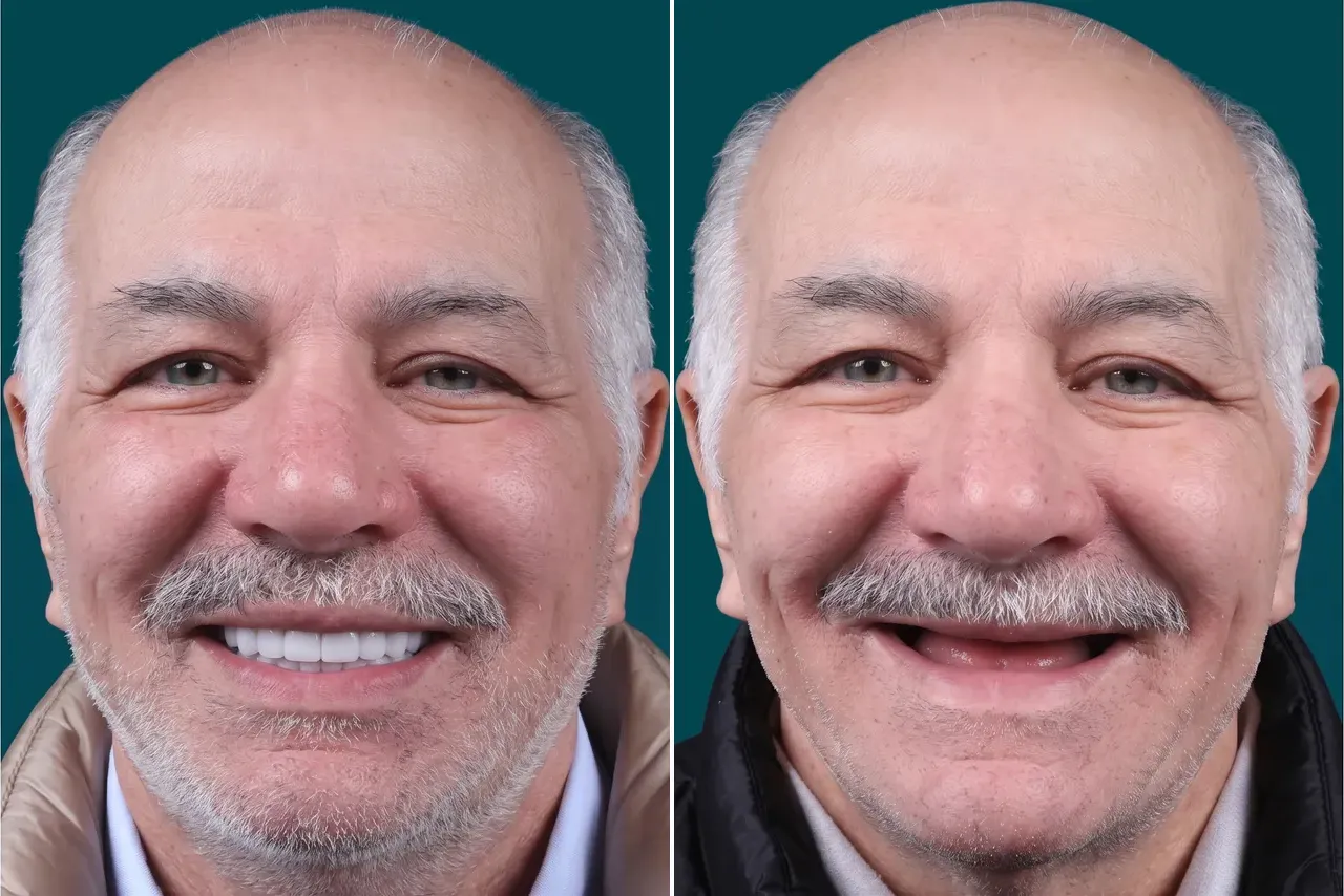  Dental Implants-All-on-6 4