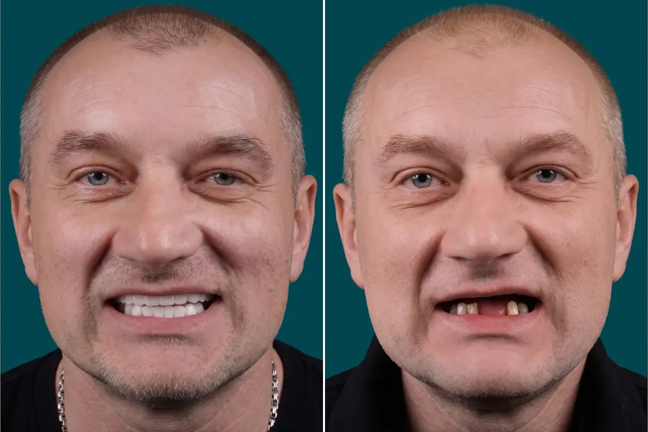  Dental Implants-All-on-6 5