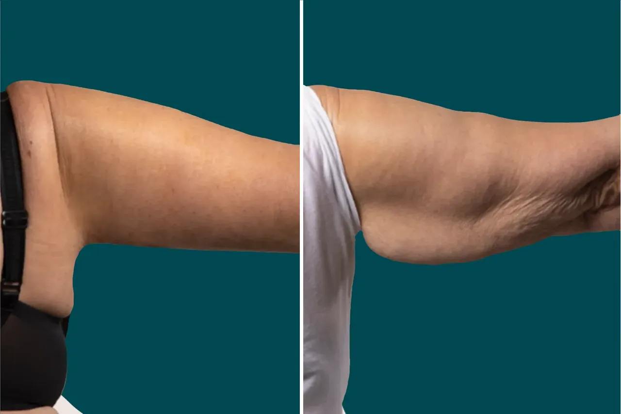 Arm Liposuction Before After In Turkey 1