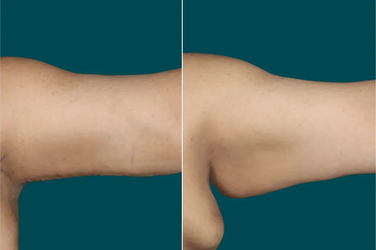 Arm Liposuction Before After In Turkey 2