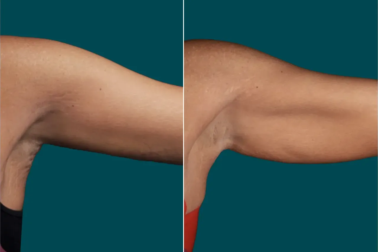 Arm Liposuction Before After In Turkey 3