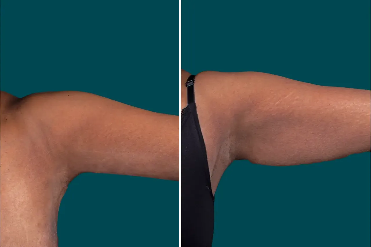 Arm Liposuction Before After In Turkey 4