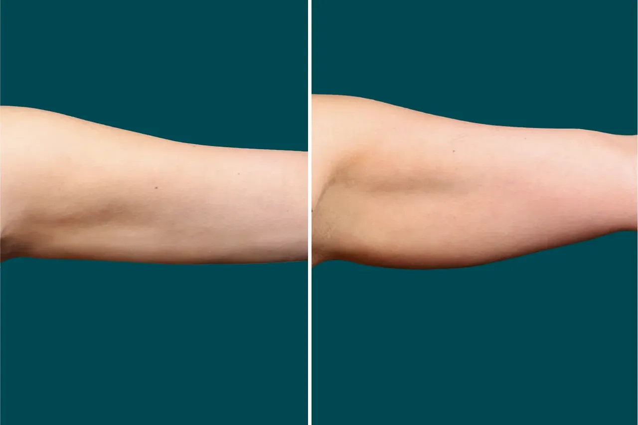 Arm Liposuction Before After In Turkey 5