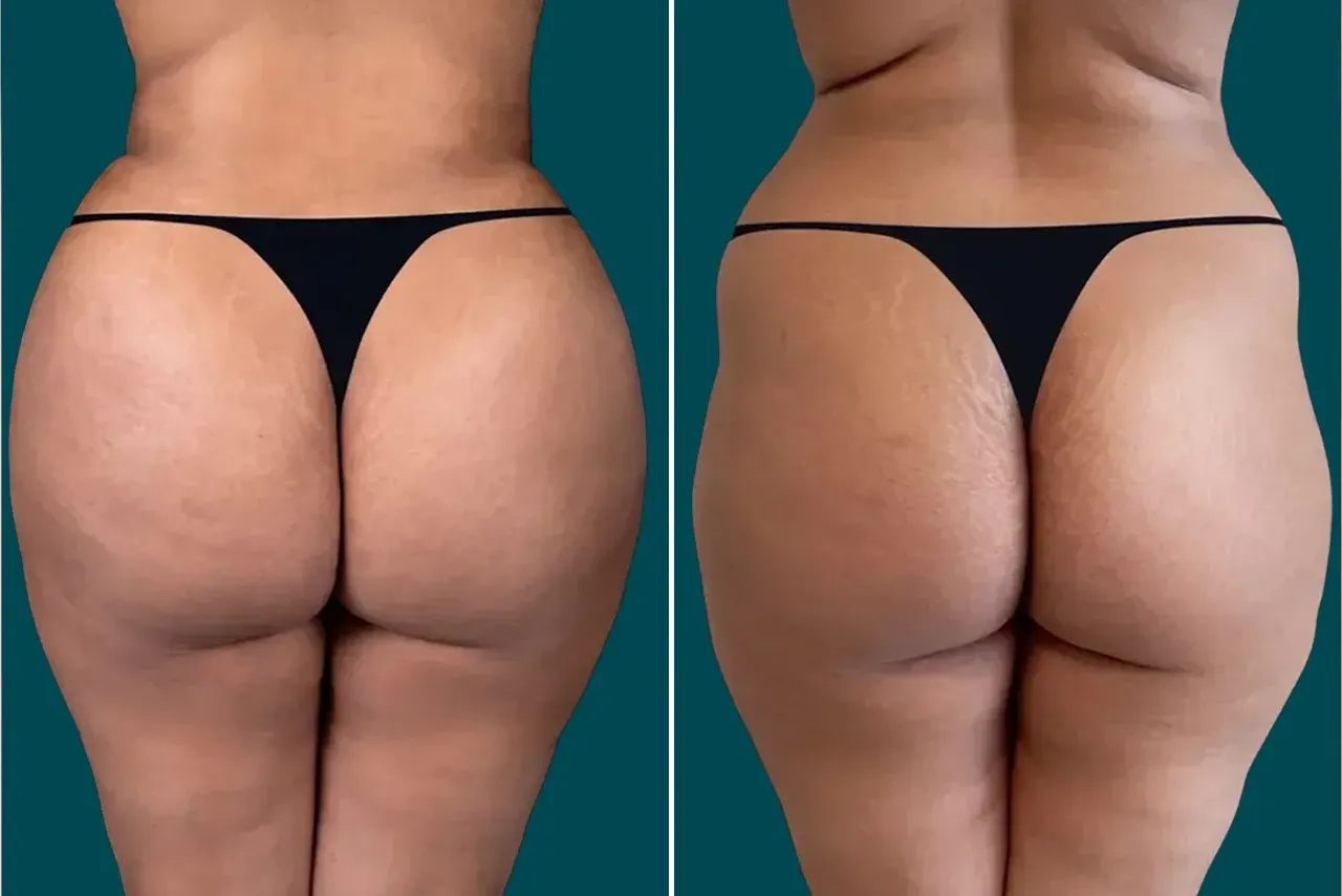 Brazilian Butt Lift - BBL 1