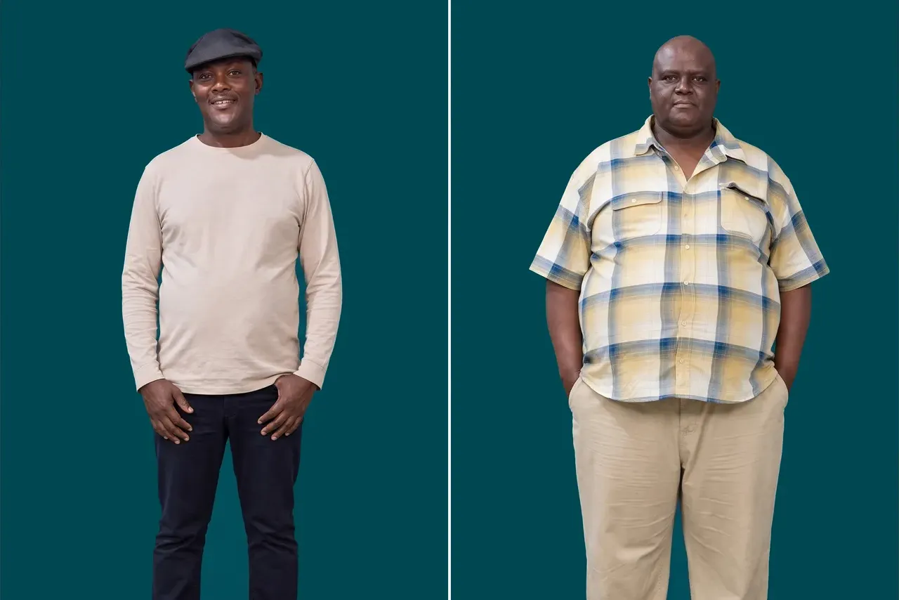 Weight Loss Surgery-Gastric Sleeve 1