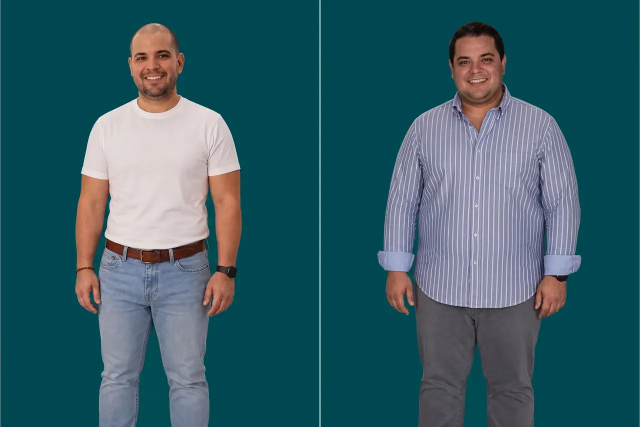 Weight Loss Surgery-Gastric Sleeve 3