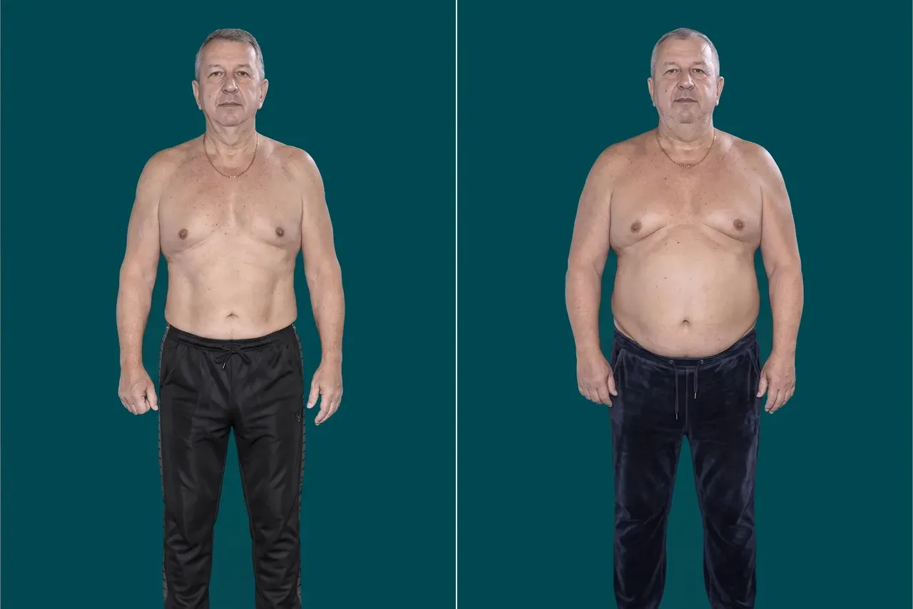 Weight Loss Surgery 14