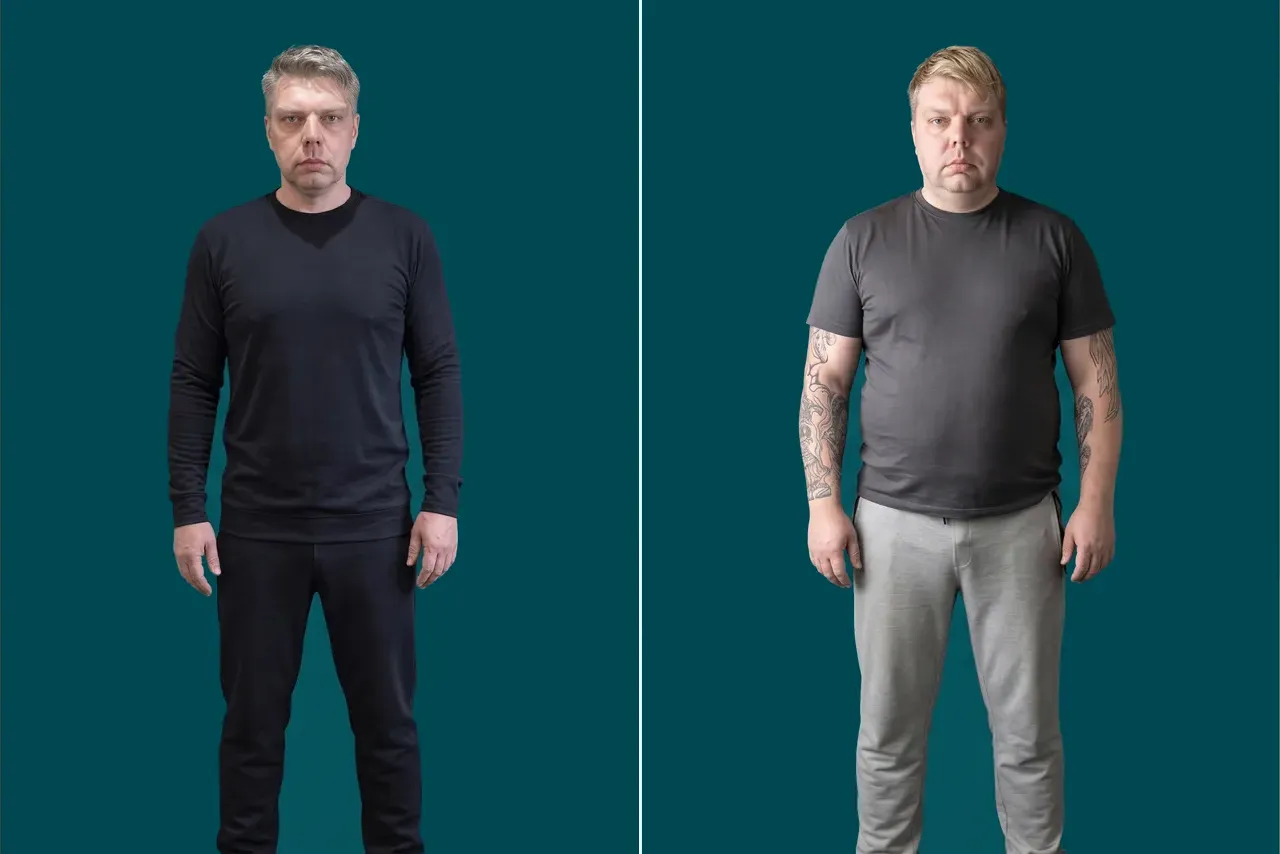 Weight Loss Surgery 15
