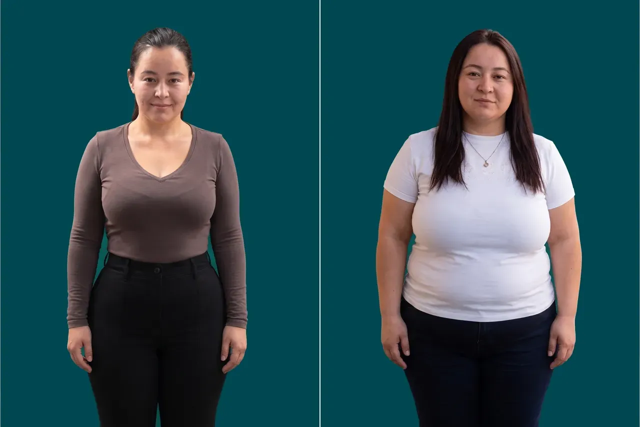 Weight Loss Surgery-Gastric Botox 2