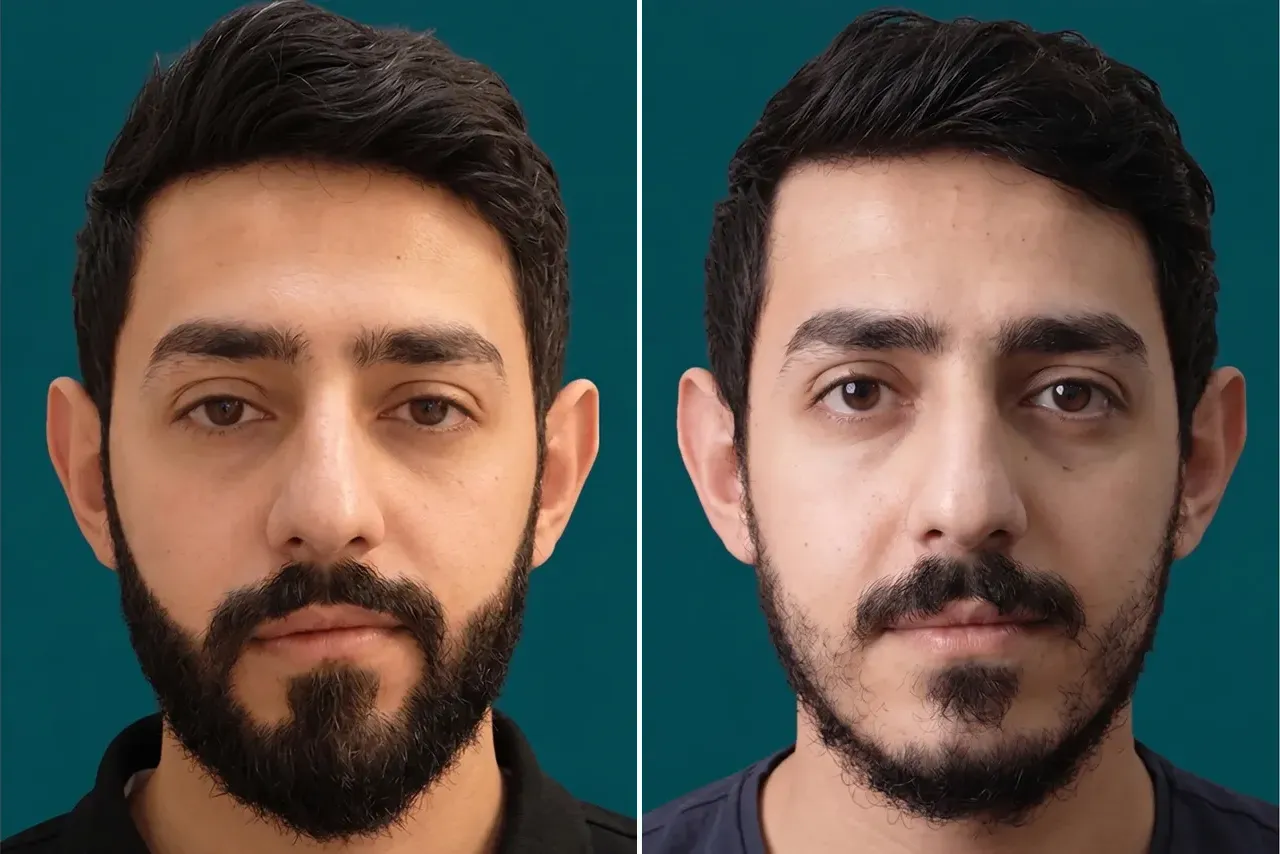 Beard Transplant 2