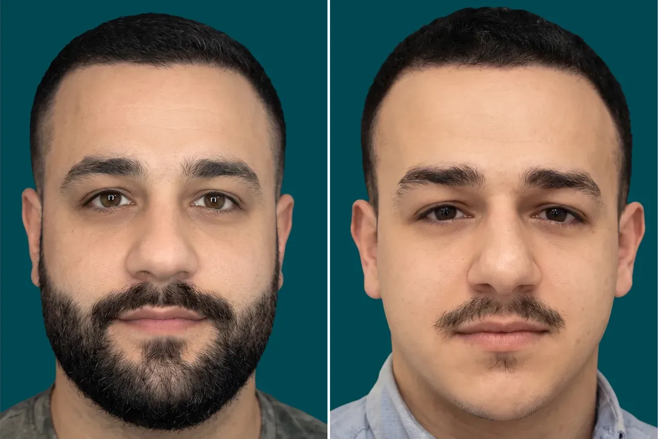 Beard Transplant 1