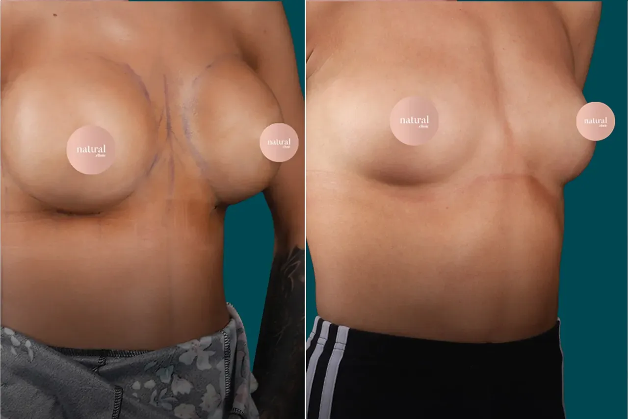 Breast Augmentation Before and After 10