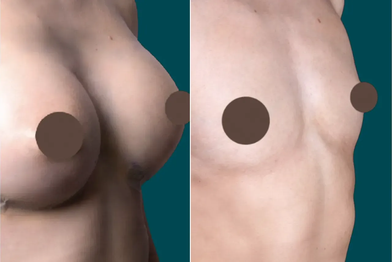 Breast Augmentation Before and After 11