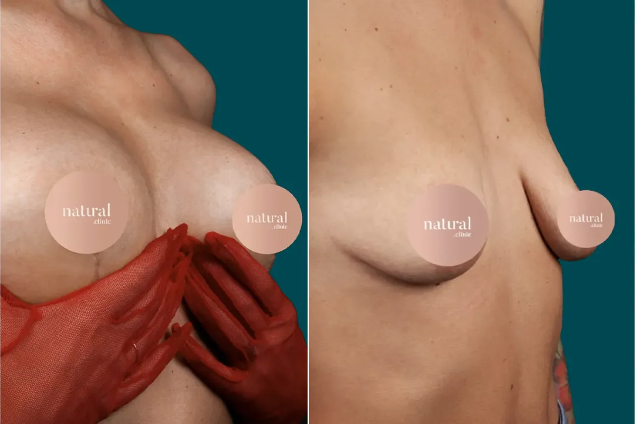 Breast Augmentation Before and After 12