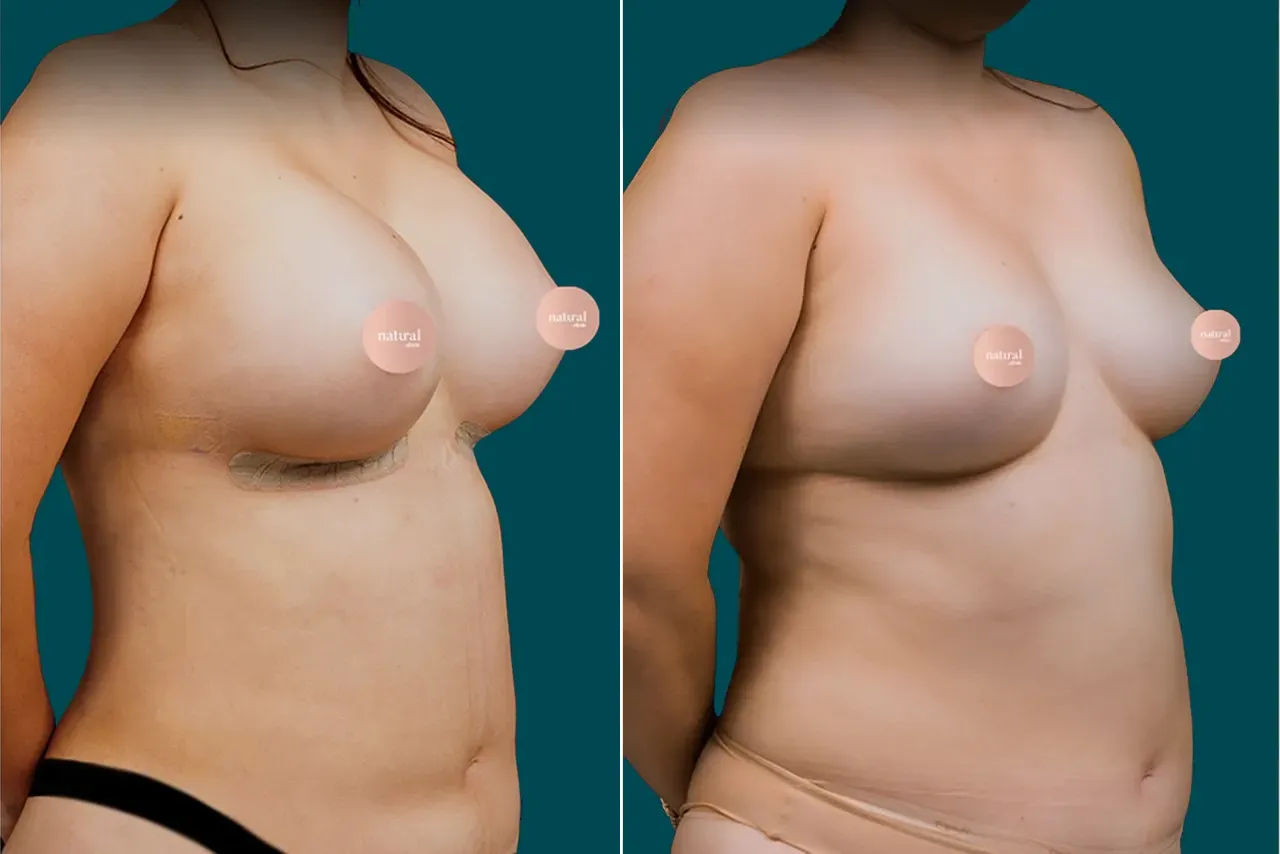 Breast Augmentation Before and After 13