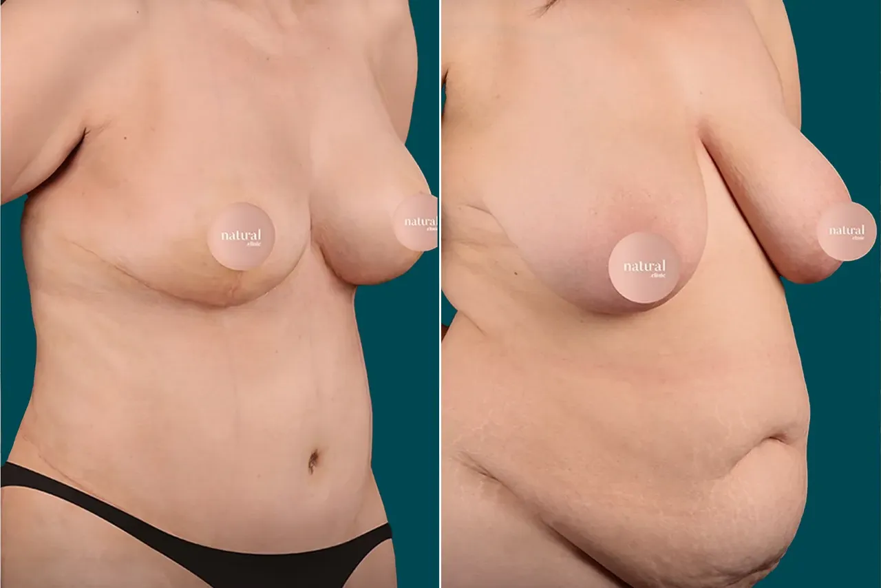 Breast Augmentation Before and After 14