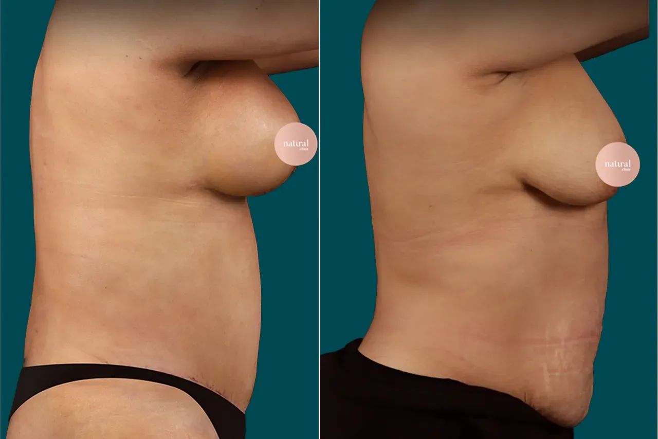 Breast Augmentation Before and After 15