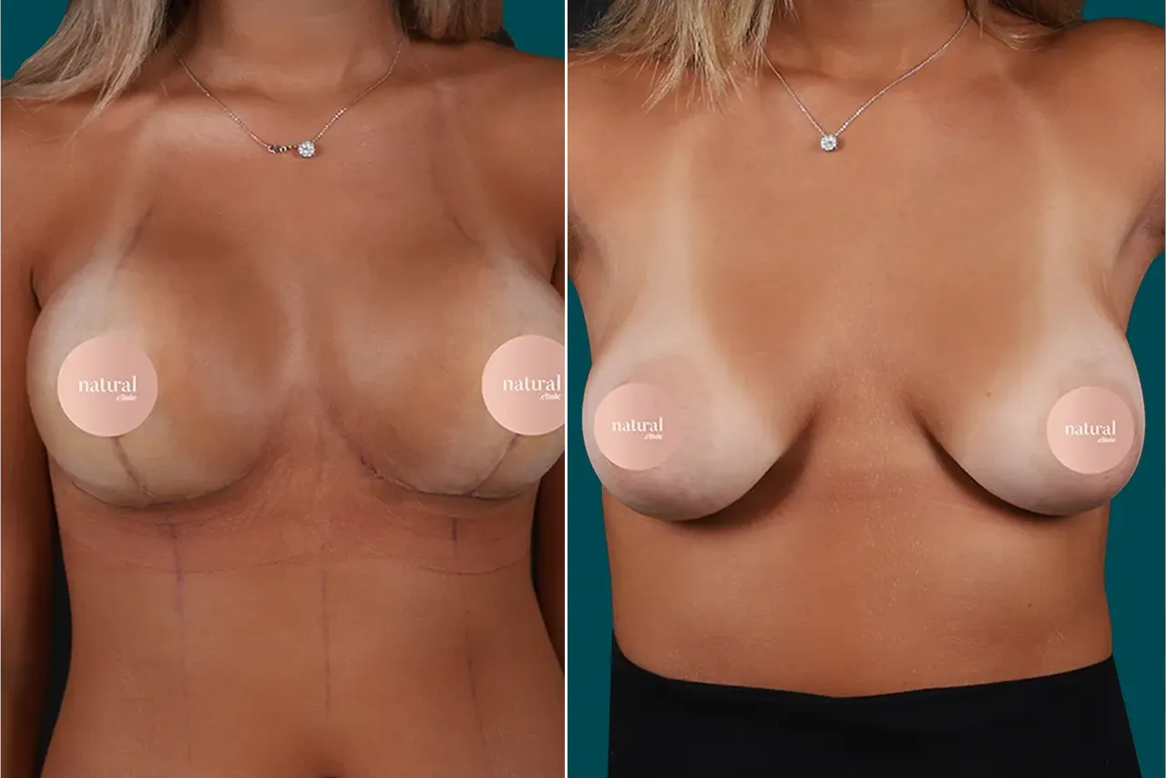 Breast Augmentation Before and After 16