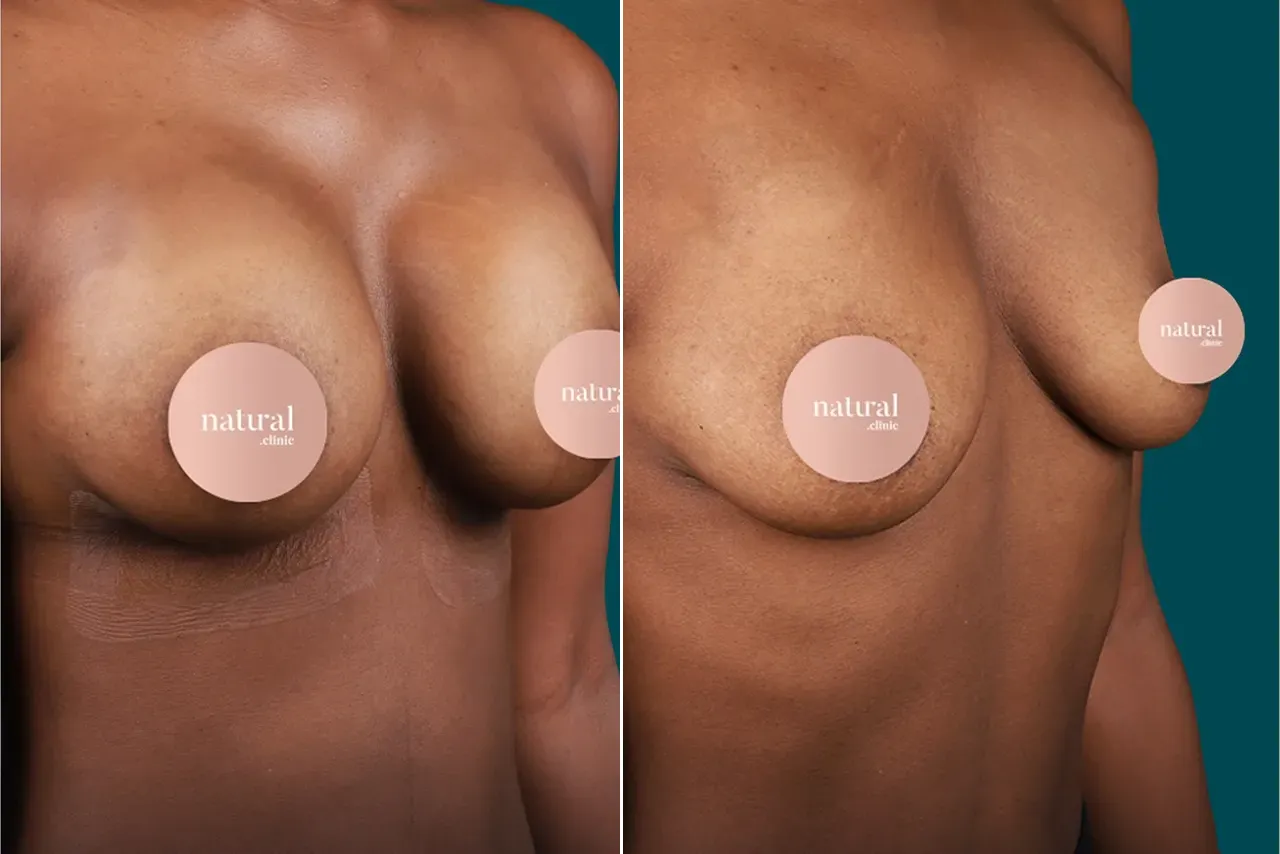Breast Augmentation Before and After 2